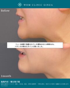 『先天的な魔女顎(Chin Ptosis)の治療|骨切りなしで改善する最新手術法』の画像