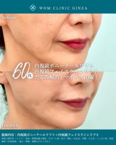 『皮膚を切るフェイスリフトの意味|切開 vs 内視鏡フェイスリフトの適応と基準』の画像