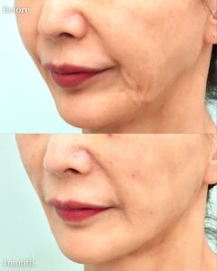 『皮膚を切るフェイスリフトの意味|切開 vs 内視鏡フェイスリフトの適応と基準』の画像