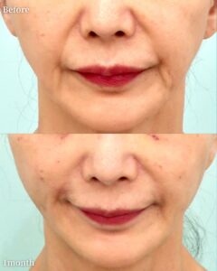 『皮膚を切るフェイスリフトの意味|切開 vs 内視鏡フェイスリフトの適応と基準』の画像