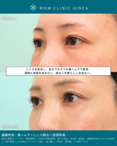 『しこり除去は裏側から|傷跡を残さず安全に取る“裏ハムラ式アプローチ”』の画像