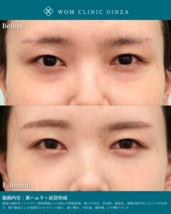 『涙袋形成でさらに可愛く|安定した結果を出すための最新技術と症例紹介』の画像