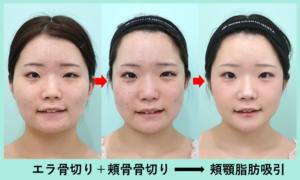 エラ骨切り＋頬骨骨切り（頬骨縮小）＋頬＋顎下の脂肪吸引の症例写真