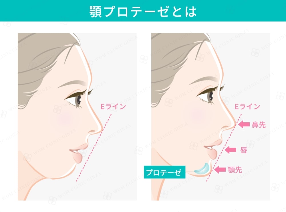 顎プロテーゼとは