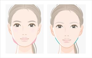 エラ張りの改善法