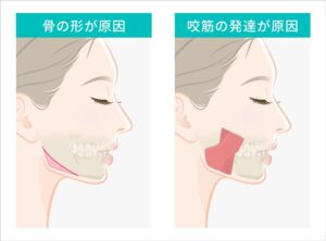 エラ張りの原因