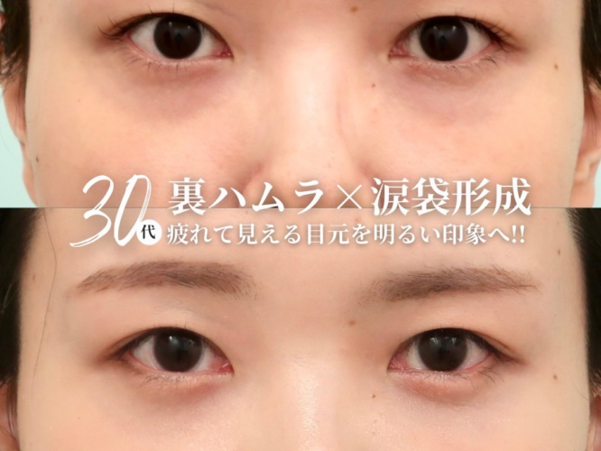 裏ハムラ、涙袋形成