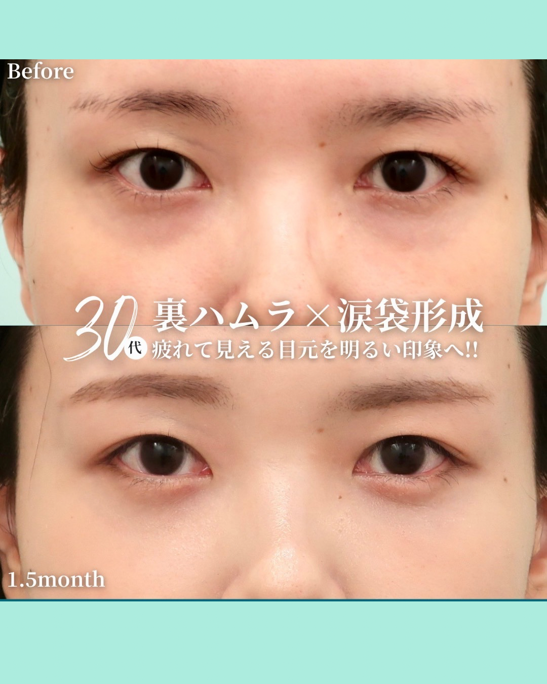 裏ハムラ、涙袋形成