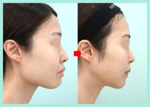 Vライン形成の症例写真02