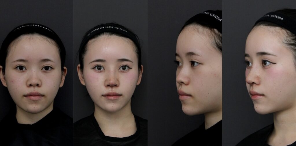 『初回鼻整形:自家組織のみで高さと立体感を整えた症例』の画像