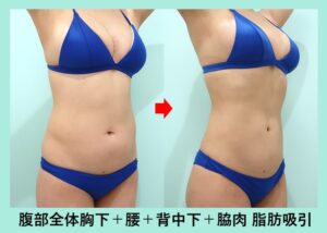 腹部全体＋胸下＋腰＋脇肉＋背中下の脂肪吸引の症例写真