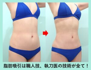 腹部全体＋胸下＋腰＋背中上下の脂肪吸引の症例02
