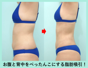 腹部全体＋胸下＋腰＋背中下の脂肪吸引の症例写真02