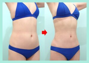 腹部全体＋胸下＋腰＋背中上下脂肪吸引の症例写真
