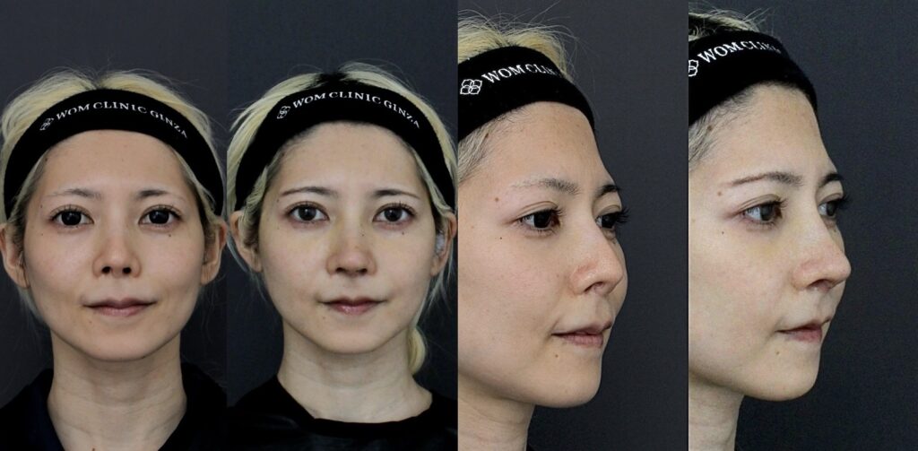 『他院修正:吊り上がった鼻先を自然な角度へ』の画像