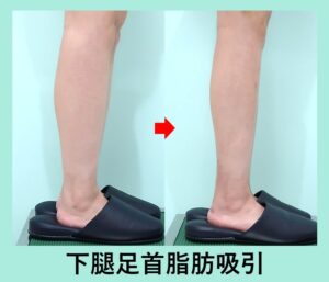 脹脛足首セット＋前足首の脂肪吸引の症例写真