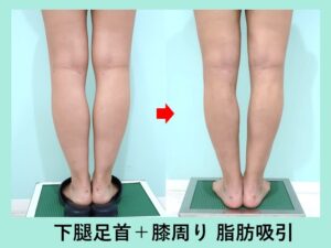 ふくらはぎ＋膝内＋膝上＋足首の脂肪吸引の症例写真