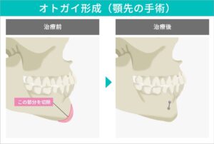 オトガイ形成（顎先の手術）