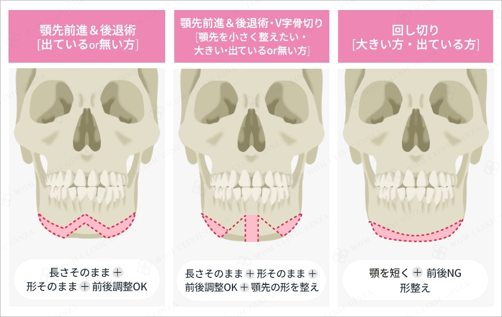 オトガイ形成の種類