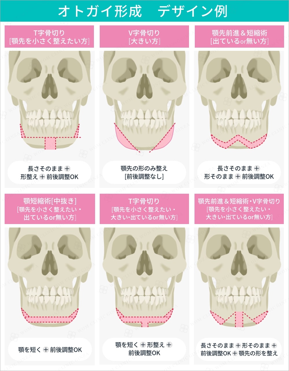 オトガイ形成デザイン例