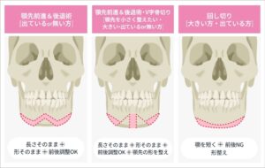 オトガイ形成のデザイン