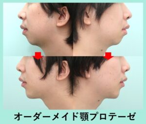 顎オーダープロテーゼの症例写真