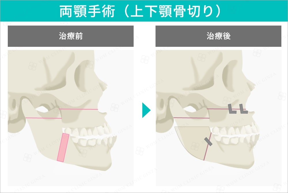 両顎手術（上下顎骨切り）