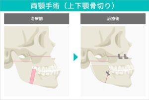 両顎手術（上下顎骨切り）