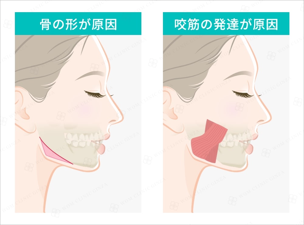 エラ張りの原因