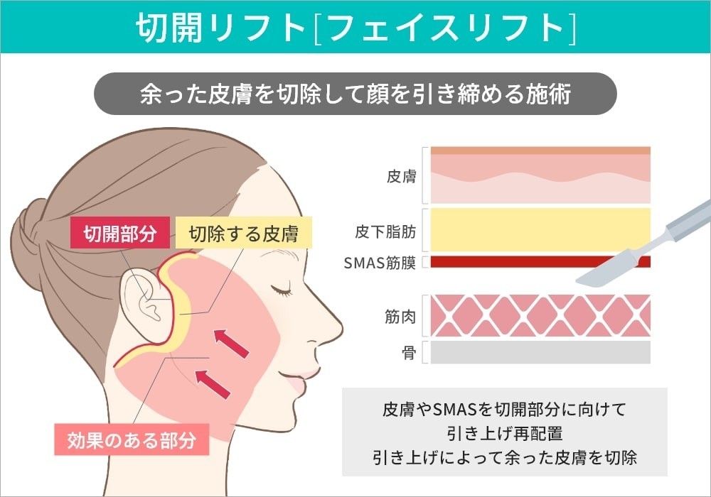 フェイスリフト - 東京・銀座の美容外科クリニック｜WOM CLINIC GINZA
