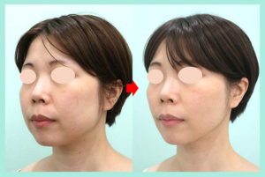 頬+顎下の脂肪吸引+バッカルファット除去+糸リフト+エラボトックスの症例写真