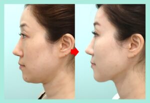 脂肪注入＋頬・顎下脂肪吸引の症例写真
