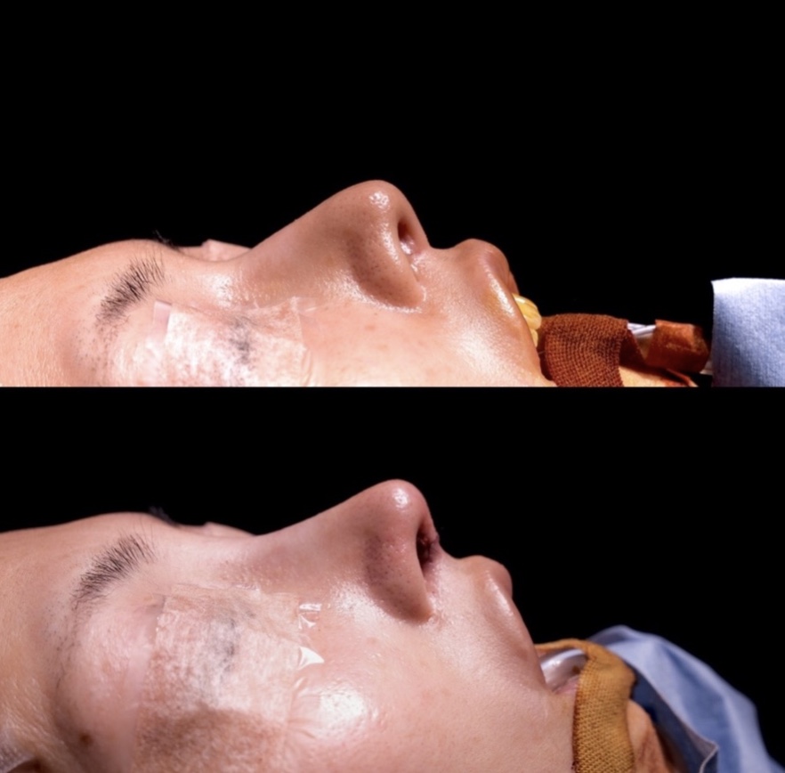 『他院修正:吊り上がった鼻先を自然な角度へ』の画像