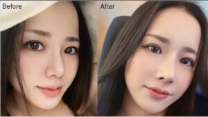 鼻フル整形の症例写真