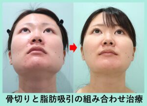 エラ骨切り＋脂肪吸引の症例写真