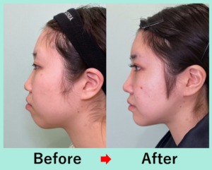 韓国式輪郭3点＋頬・顎下の脂肪吸引＋バッカルファット除去の症例写真02