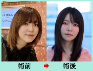 韓国式輪郭3点の症例写真01