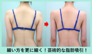二の腕・肩＋付け根の脂肪吸引の症例写真