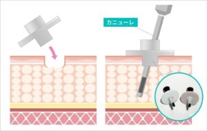 脂肪吸引のダウンタイム