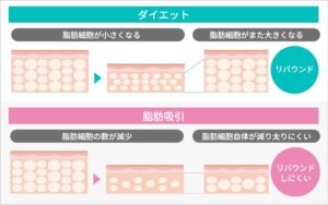 脂肪吸引のメリット