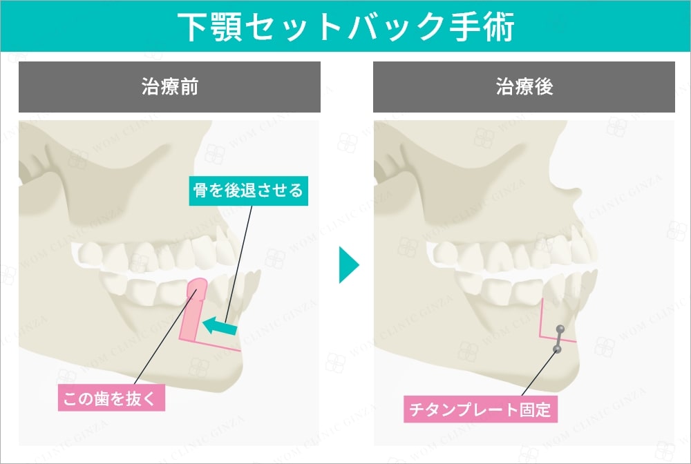 下顎セットバック手術
