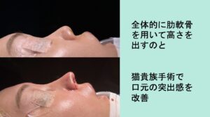 鼻中隔延長＋肋軟骨移植＋鼻尖形成（耳介軟骨移植）＋自家組織隆鼻＋小鼻縮小（外側法）の症例写真