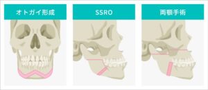 骨切り手術の種類