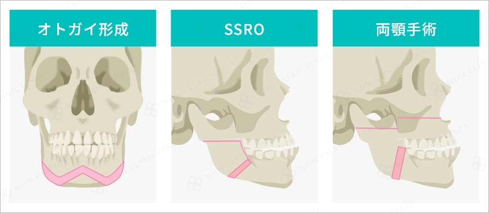 骨切り手術の種類