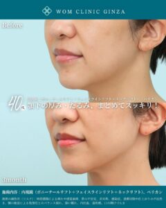 内視鏡ポニーテールリフト+内視鏡フェイスラインリフト+内視鏡ネックリフトの症例写真
