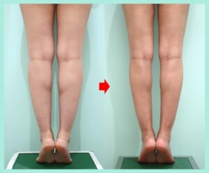 太もも全周＋膝上＋膝内＋ふくらはぎ＋足首の脂肪吸引の症例写真