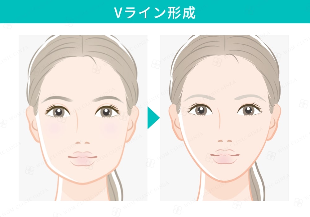 Vライン形成