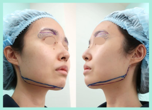 Vライン形成の施術箇所