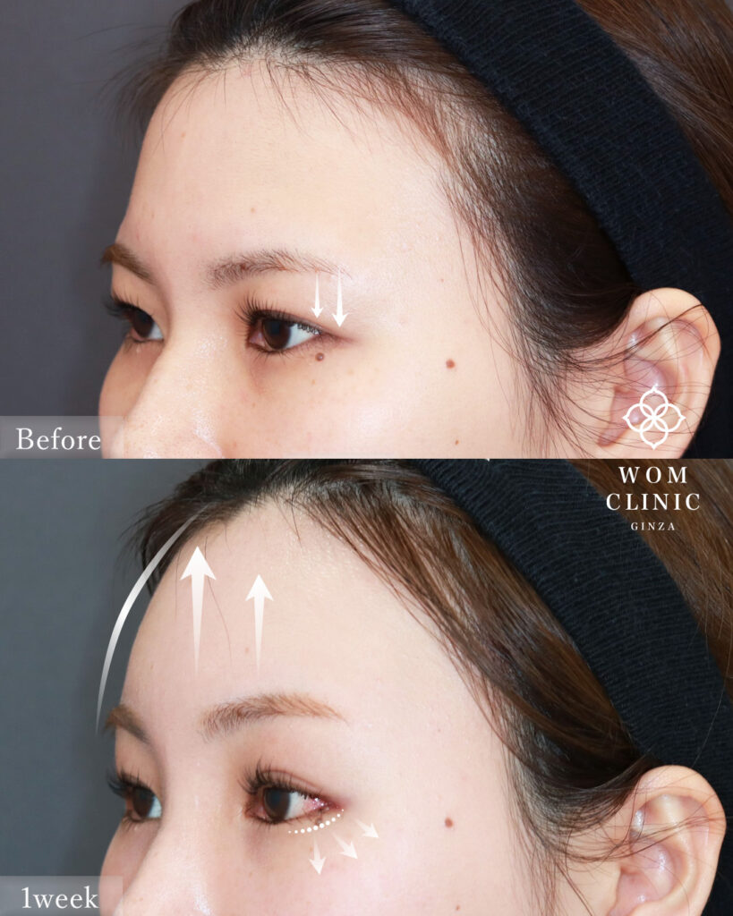 『「奥目」の原因は骨にあり？アイホールボーン削りで目元を明るく』の画像