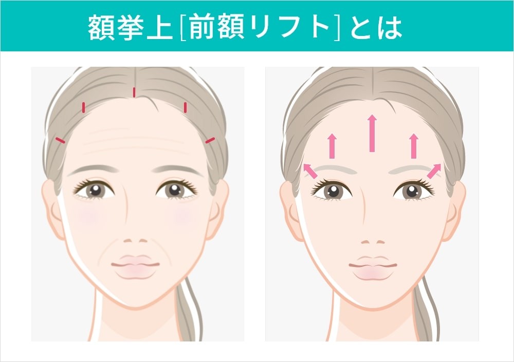 額挙上(前額リフト)